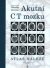 Akutní CT mozku