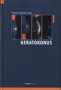 Keratokonus